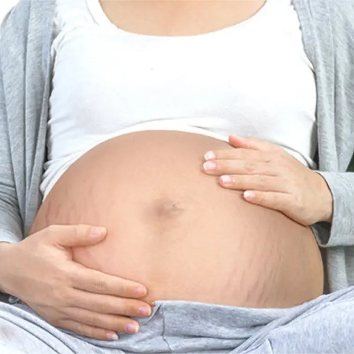 how-to-prevent-stretch-marks-during-pregnancy-dermatouch
