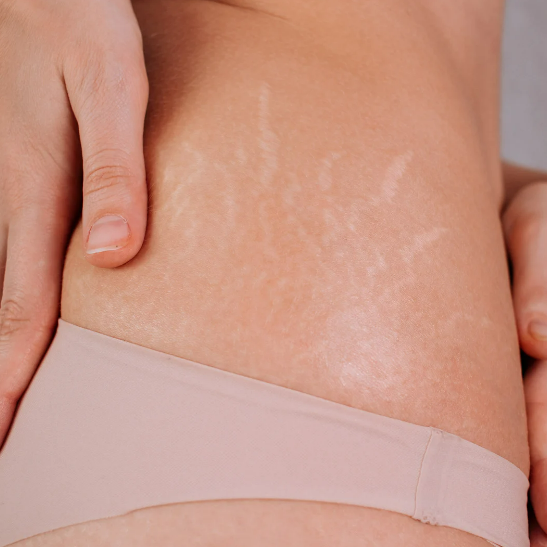an-in-depth-guide-why-stretch-marks-cream-is-essential-for-removing-marks-dermatouch