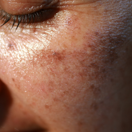 why-pigmentation-cream-is-essential-for-hyperpigmentation-treatment-dermatouch