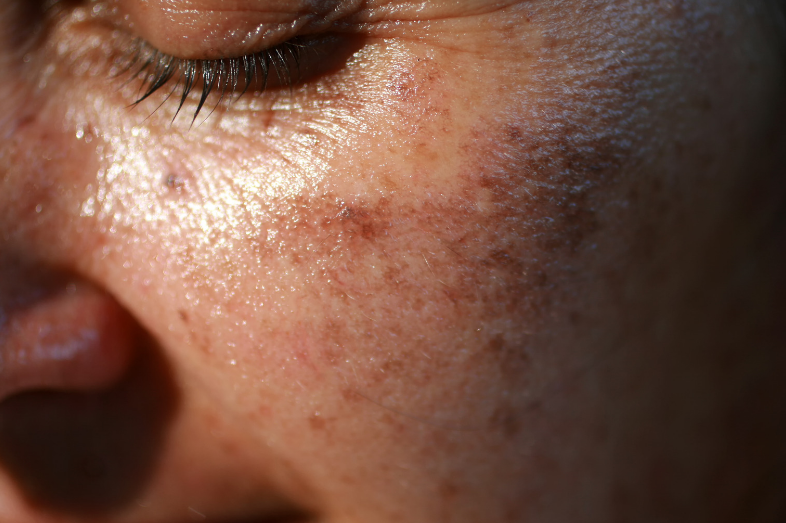 why-pigmentation-cream-is-essential-for-hyperpigmentation-treatment-dermatouch