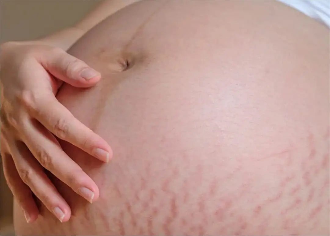 what-are-pregnancy-stretch-marks-causes-and-treatments-dermatouch