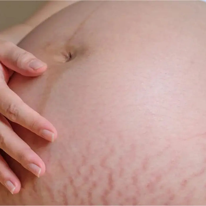 what-are-pregnancy-stretch-marks-causes-and-treatments-dermatouch