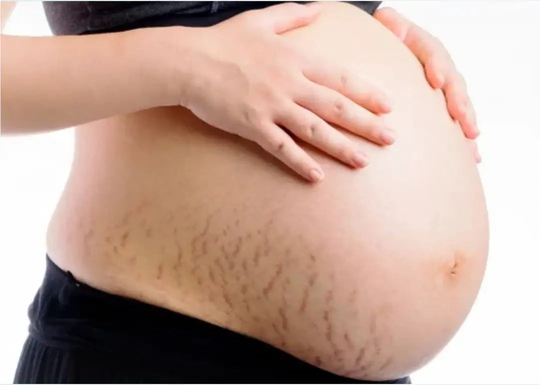 worried-about-pregnancy-stretch-marks-when-to-start-using-stretch-mark-cream-during-pregnancy-dermatouch