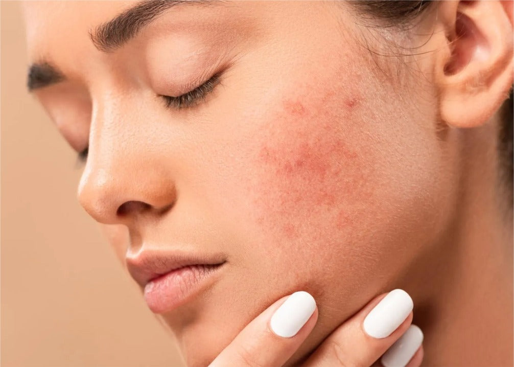 What are dark spots on the skin and how to treat them?