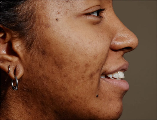 How to Remove Dark Spots: Sunspots, Age Spots, and Acne Woes Revealed!