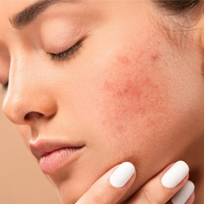 What are dark spots on the skin and how to treat them?