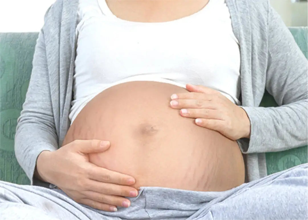 How to Prevent Stretch Marks During Pregnancy?