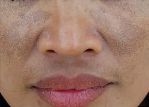 How to reduce pigmentation around mouth