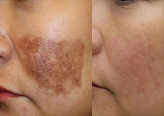 How to remove pigmentation from face permanently