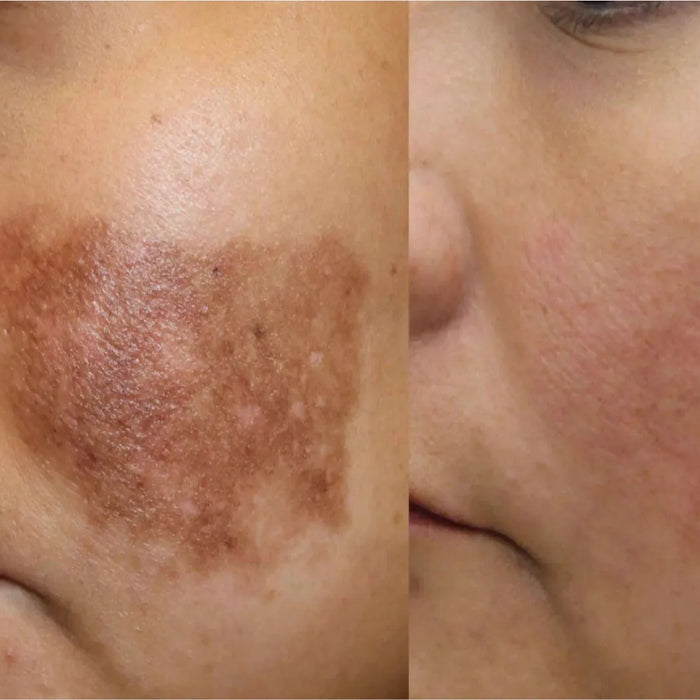 How to remove pigmentation from face permanently