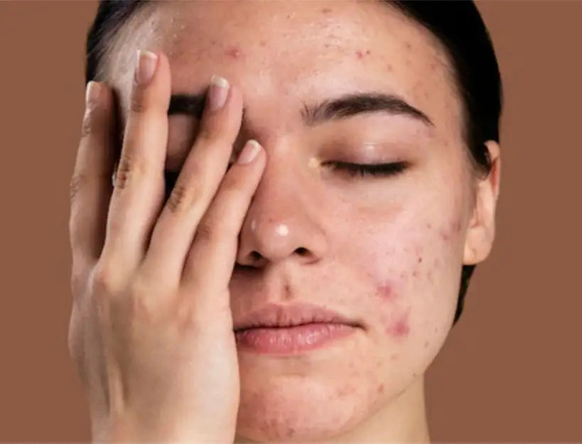 How to remove dark spots on face fast