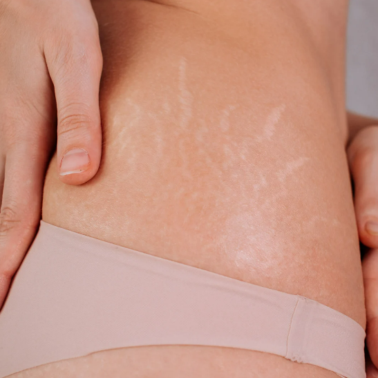 An In-Depth Guide: Why Stretch Marks Cream is Essential for Removing Marks