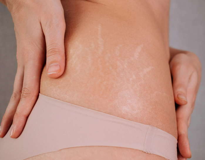 An In-Depth Guide: Why Stretch Marks Cream is Essential for Removing Marks