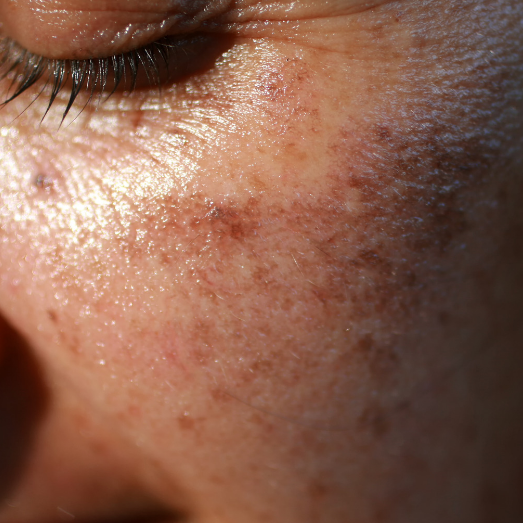 Why Pigmentation Cream Is Essential for Hyperpigmentation Treatment