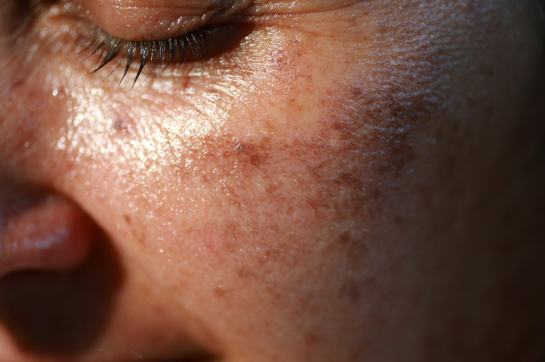 Why Pigmentation Cream Is Essential for Hyperpigmentation Treatment