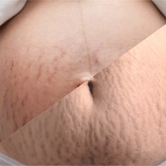 Tips To Prevent Stretch Marks During & After Pregnancy