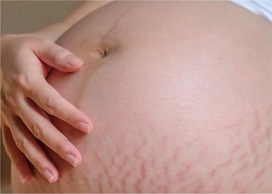 What Are Pregnancy Stretch Marks? Causes and Treatments