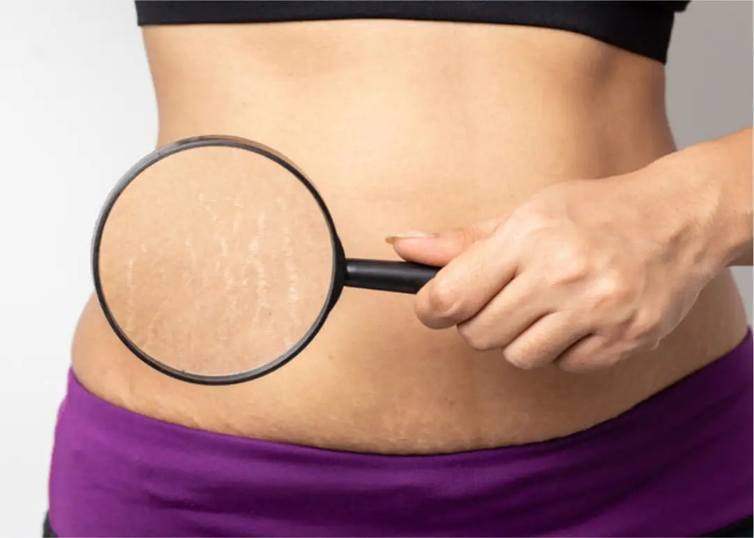 What are stretch marks? How to get rid of stretch marks during pregnancy?