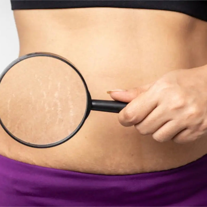 What are stretch marks? How to get rid of stretch marks during pregnancy?