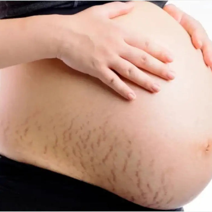Worried About Pregnancy Stretch Marks? When to start using stretch mark cream during pregnancy?