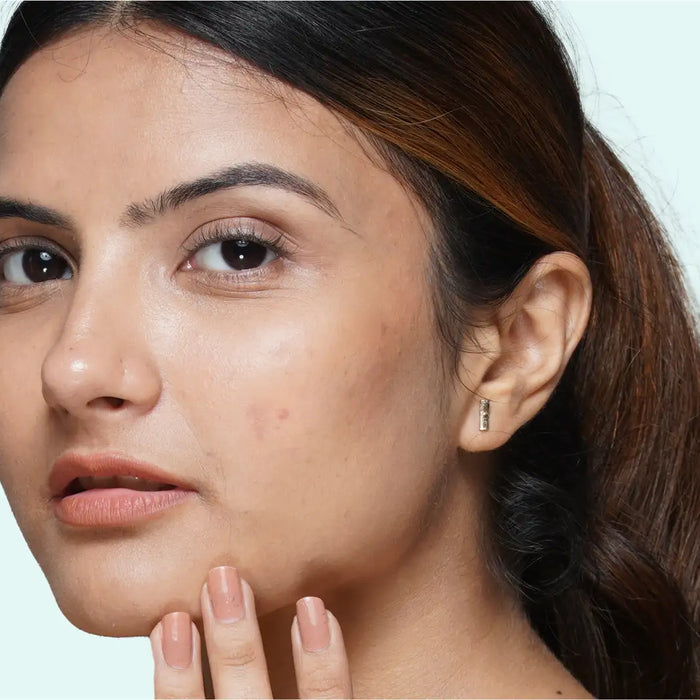 How to remove pimple marks overnight?