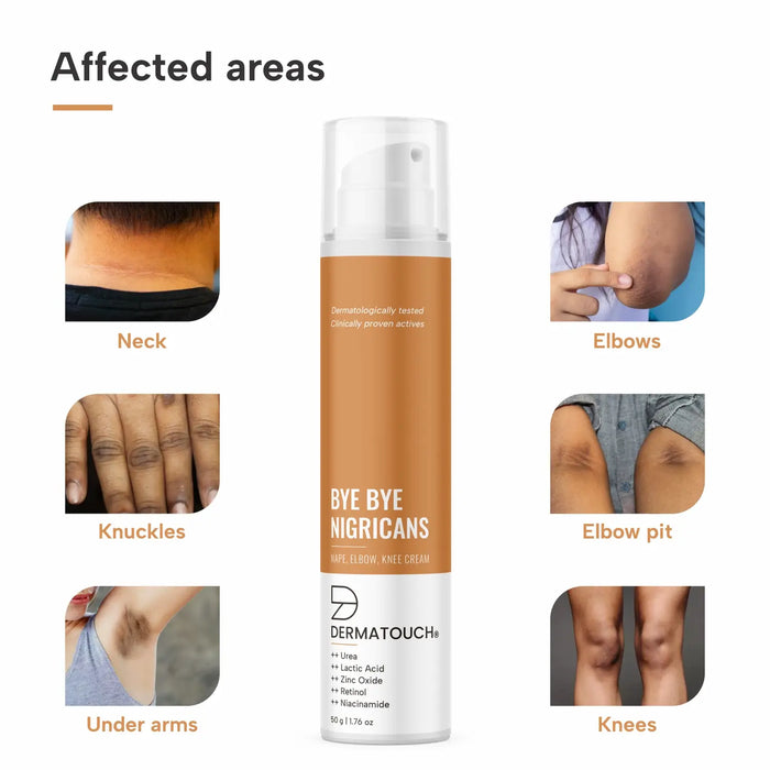 affected areas for bye bye pigmentation cream