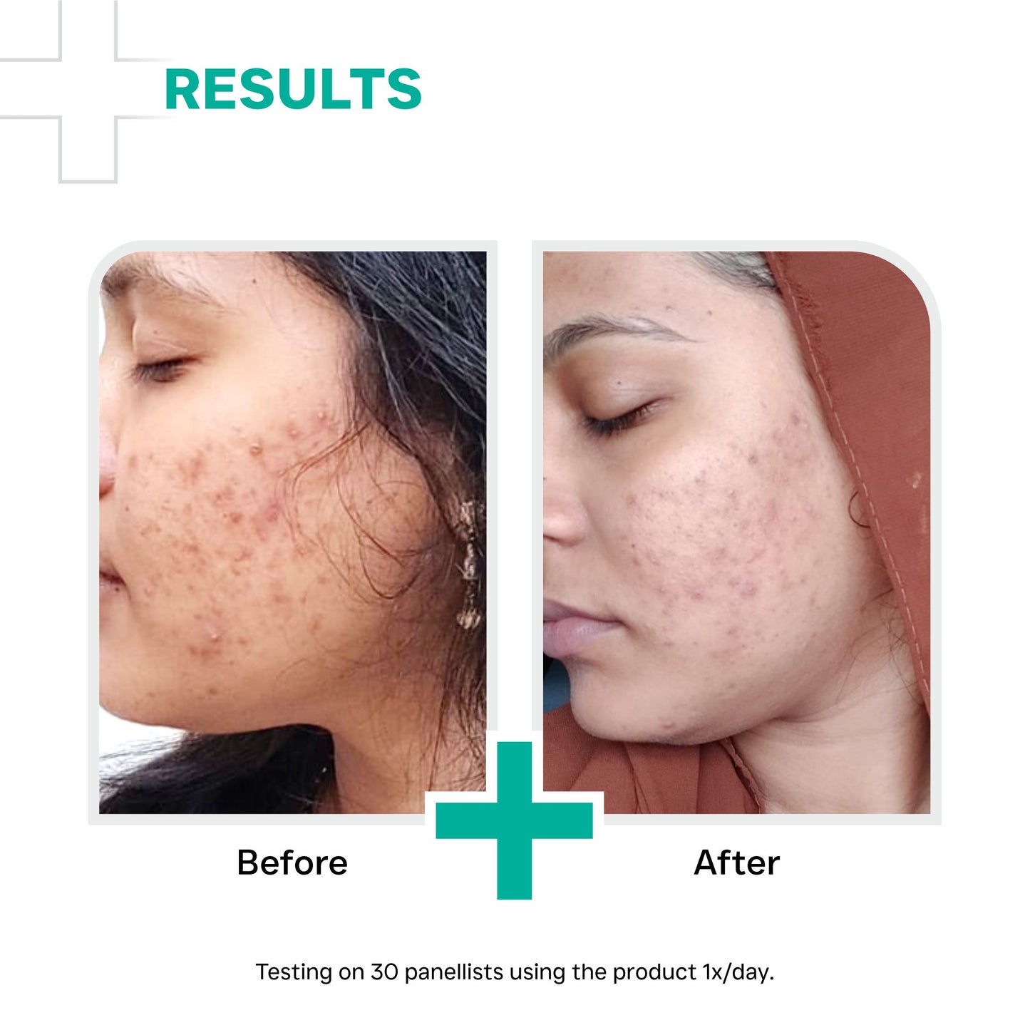 சாலிசிலிக் அமிலம் 2% நியாசினமைடு 6% எண்ணெய் இல்லாத ஜெல் 30 கிராம்