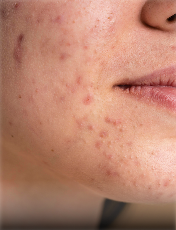 Acne skincare concern
