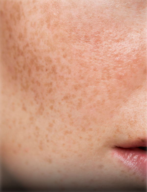 Pigmentation skincare concern