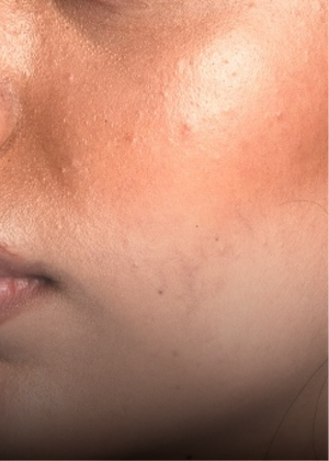 Combination Skin skincare concern