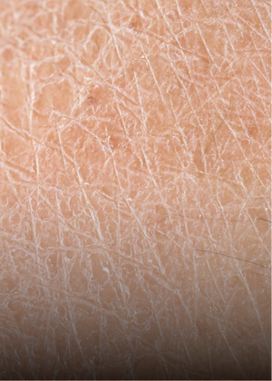Dry Skin skincare concern
