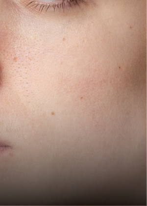 Normal Skin skincare concern