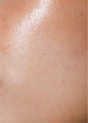 Oily Skin